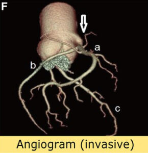 This image shows Cardiovascular Imaging - Angiogram Invasive - Echocardiography to Visualize the Heart 