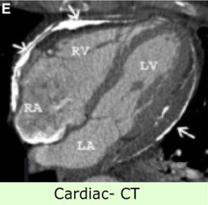 This image shows Cardiovascular Imaging - CT - Echocardiography to Visualize the Heart 