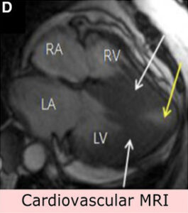 This image shows Cardiovascular Imaging - MRI - Echocardiography to Visualize the Heart 