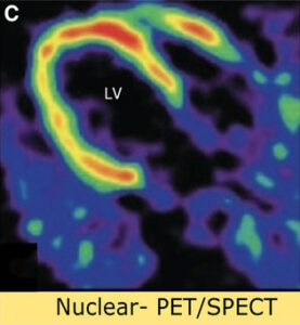 This image shows Cardiovascular Imaging - PET CT - Echocardiography to Visualize the Heart 