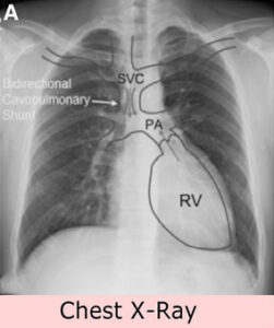 This image shows Cardiovascular Imaging - X-ray - Echocardiography to Visualize the Heart 