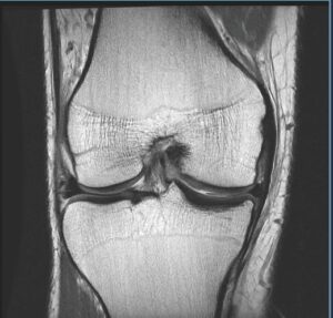 Knee MRI