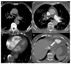 Pulmonary Embolism CTA Scan