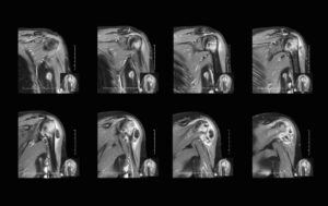 Shoulder MRI Arthrogram