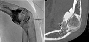 Arthrogram of elbow